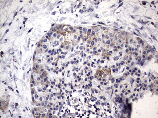 MTDH / Metadherin Antibody - Immunohistochemical staining of paraffin-embedded Carcinoma of Human pancreas tissue using anti-MTDH mouse monoclonal antibody. (Heat-induced epitope retrieval by 1 mM EDTA in 10mM Tris, pH8.5, 120C for 3min,