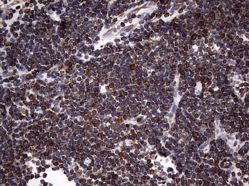 MTDH / Metadherin Antibody - Immunohistochemical staining of paraffin-embedded Human lymphoma tissue using anti-MTDH mouse monoclonal antibody. (Heat-induced epitope retrieval by 1 mM EDTA in 10mM Tris, pH8.5, 120C for 3min,