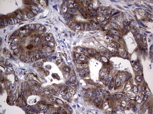 MTDH / Metadherin Antibody - Immunohistochemical staining of paraffin-embedded Adenocarcinoma of Human colon tissue using anti-MTDH mouse monoclonal antibody. (Heat-induced epitope retrieval by 1 mM EDTA in 10mM Tris, pH8.5, 120C for 3min,
