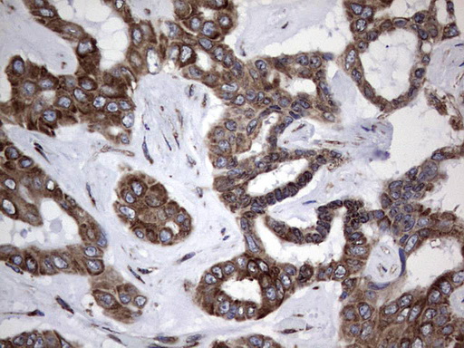 MTDH / Metadherin Antibody - Immunohistochemical staining of paraffin-embedded Carcinoma of Human liver tissue using anti-MTDH mouse monoclonal antibody. (Heat-induced epitope retrieval by 1 mM EDTA in 10mM Tris, pH8.5, 120C for 3min,