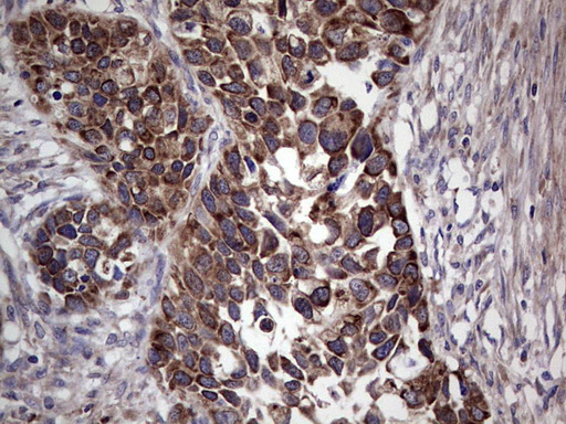 MTDH / Metadherin Antibody - Immunohistochemical staining of paraffin-embedded Carcinoma of Human kidney tissue using anti-MTDH mouse monoclonal antibody. (Heat-induced epitope retrieval by 1 mM EDTA in 10mM Tris, pH8.5, 120C for 3min,