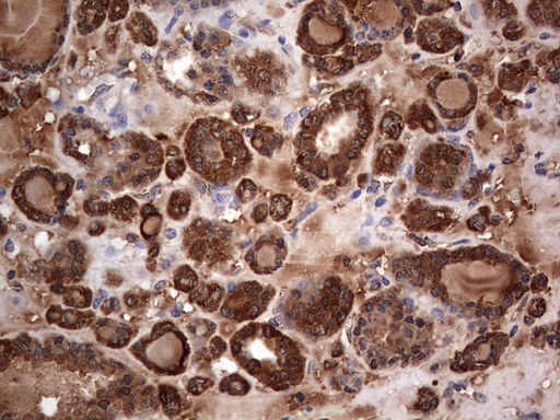 MTDH / Metadherin Antibody - IHC of paraffin-embedded Carcinoma of Human thyroid tissue using anti-MTDH mouse monoclonal antibody. (Heat-induced epitope retrieval by 1 mM EDTA in 10mM Tris, pH8.5, 120°C for 3min).