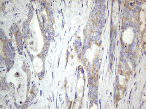 MTDH / Metadherin Antibody - IHC of paraffin-embedded Adenocarcinoma of Human colon tissue using anti-MTDH mouse monoclonal antibody. (Heat-induced epitope retrieval by 1 mM EDTA in 10mM Tris, pH8.5, 120°C for 3min).