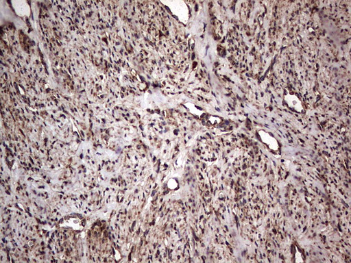 MTDH / Metadherin Antibody - IHC of paraffin-embedded Adenocarcinoma of Human endometrium tissue using anti-MTDH mouse monoclonal antibody. (Heat-induced epitope retrieval by 1 mM EDTA in 10mM Tris, pH8.5, 120°C for 3min).