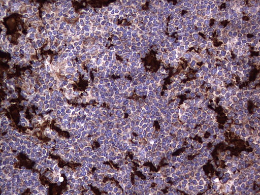 MTDH / Metadherin Antibody - IHC of paraffin-embedded Human lymphoma tissue using anti-MTDH mouse monoclonal antibody. (Heat-induced epitope retrieval by 1 mM EDTA in 10mM Tris, pH8.5, 120°C for 3min).