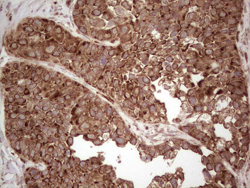 MTDH / Metadherin Antibody - IHC of paraffin-embedded Carcinoma of Human kidney tissue using anti-MTDH mouse monoclonal antibody. (Heat-induced epitope retrieval by 1 mM EDTA in 10mM Tris, pH8.5, 120°C for 3min).