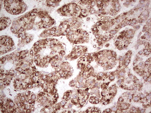 MTDH / Metadherin Antibody - IHC of paraffin-embedded Carcinoma of Human liver tissue using anti-MTDH mouse monoclonal antibody. (Heat-induced epitope retrieval by 1 mM EDTA in 10mM Tris, pH8.5, 120°C for 3min).