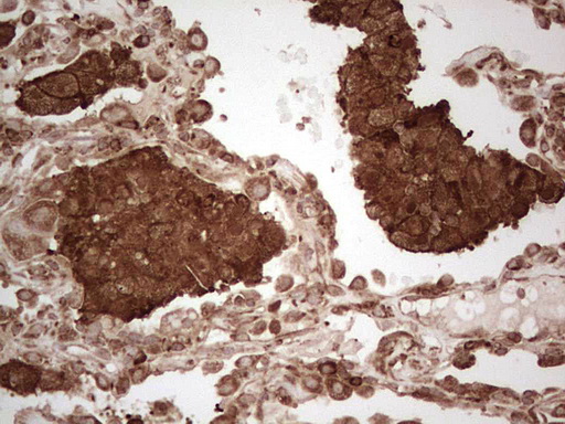 MTDH / Metadherin Antibody - IHC of paraffin-embedded Carcinoma of Human lung tissue using anti-MTDH mouse monoclonal antibody. (Heat-induced epitope retrieval by 1 mM EDTA in 10mM Tris, pH8.5, 120°C for 3min).