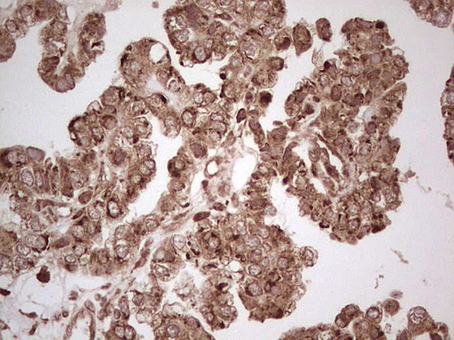 MTDH / Metadherin Antibody - IHC of paraffin-embedded Adenocarcinoma of Human ovary tissue using anti-MTDH mouse monoclonal antibody. (Heat-induced epitope retrieval by 1 mM EDTA in 10mM Tris, pH8.5, 120°C for 3min).