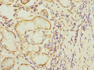 MTERF3 / MTERFD1 Antibody - Immunohistochemistry of paraffin-embedded human gastric cancer at dilution 1:100
