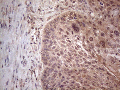 MTF-1 Antibody - Immunohistochemical staining of paraffin-embedded Carcinoma of Human lung tissue using anti-MTF1 mouse monoclonal antibody. (Heat-induced epitope retrieval by 1mM EDTA in 10mM Tris buffer. (pH8.5) at 120°C for 3 min. (1:150)