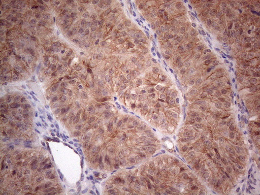 MTF-1 Antibody - Immunohistochemical staining of paraffin-embedded Adenocarcinoma of Human ovary tissue using anti-MTF1 mouse monoclonal antibody. (Heat-induced epitope retrieval by 1mM EDTA in 10mM Tris buffer. (pH8.5) at 120°C for 3 min. (1:150)