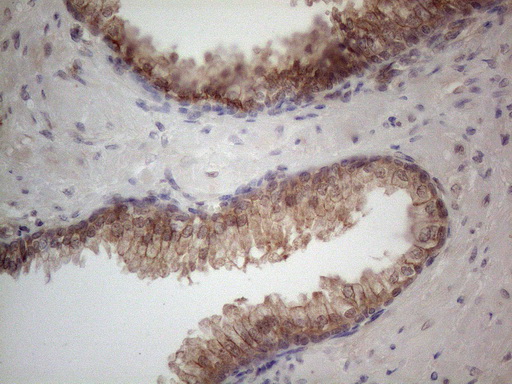 MTF-1 Antibody - Immunohistochemical staining of paraffin-embedded Human prostate tissue within the normal limits using anti-MTF1 mouse monoclonal antibody. (Heat-induced epitope retrieval by 1mM EDTA in 10mM Tris buffer. (pH8.5) at 120°C for 3 min. (1:150)