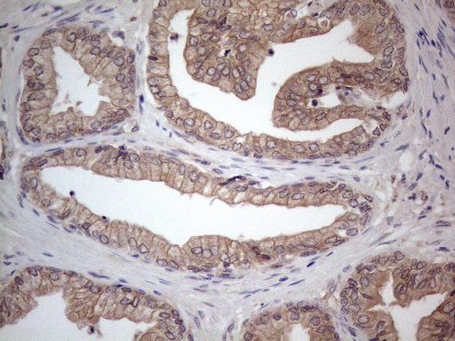 MTF-1 Antibody - Immunohistochemical staining of paraffin-embedded Carcinoma of Human prostate tissue using anti-MTF1 mouse monoclonal antibody. (Heat-induced epitope retrieval by 1mM EDTA in 10mM Tris buffer. (pH8.5) at 120°C for 3 min. (1:150)