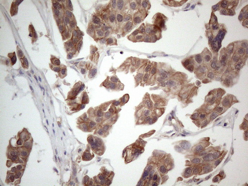 MTF-1 Antibody - Immunohistochemical staining of paraffin-embedded Carcinoma of Human bladder tissue using anti-MTF1 mouse monoclonal antibody. (Heat-induced epitope retrieval by 1mM EDTA in 10mM Tris buffer. (pH8.5) at 120°C for 3 min. (1:150)