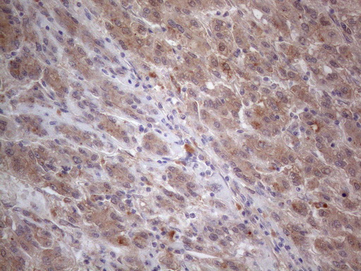MTF-1 Antibody - Immunohistochemical staining of paraffin-embedded Carcinoma of Human liver tissue using anti-MTF1 mouse monoclonal antibody. (Heat-induced epitope retrieval by 1mM EDTA in 10mM Tris buffer. (pH8.5) at 120°C for 3 min. (1:150)