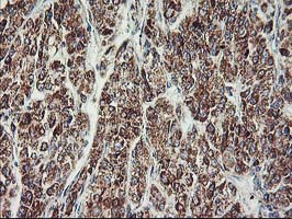 MTFMT Antibody - IHC of paraffin-embedded Carcinoma of Human liver tissue using anti-MTFMT mouse monoclonal antibody. (Heat-induced epitope retrieval by 10mM citric buffer, pH6.0, 100C for 10min).