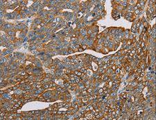 MTFP1 Antibody - Immunohistochemistry of paraffin-embedded Human cervical cancer using MTFP1 Polyclonal Antibody at dilution of 1:30.