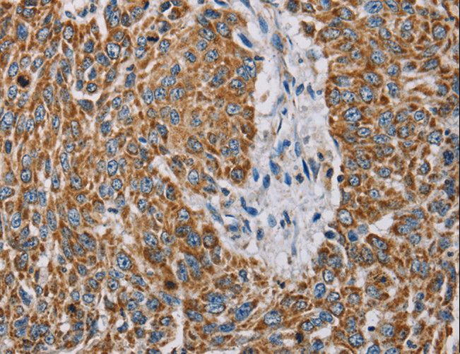 MTFP1 Antibody - Immunohistochemistry of paraffin-embedded Human lung cancer using MTFP1 Polyclonal Antibody at dilution of 1:30.