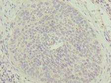 MTFP1 Antibody - Immunohistochemistry of paraffin-embedded human cervical cancer at dilution 1:100
