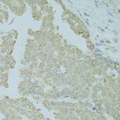 MTFP1 Antibody - Immunohistochemistry of paraffin-embedded Human colon carcinoma using MTFP1 Polyclonal Antibody at dilution of 1:100 (40x lens).
