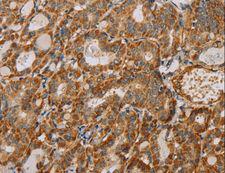 MTFR1 Antibody - Immunohistochemistry of paraffin-embedded Human thyroid cancer using MTFR1 Polyclonal Antibody at dilution of 1:40.