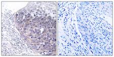 MTG2 / GTPBP5 Antibody - Immunohistochemistry analysis of paraffin-embedded human cervix carcinoma tissue, using GTPBP5 Antibody. The picture on the right is blocked with the synthesized peptide.