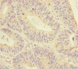 MTHFD2 Antibody - Immunohistochemistry of paraffin-embedded human colon cancer at dilution of 1:100