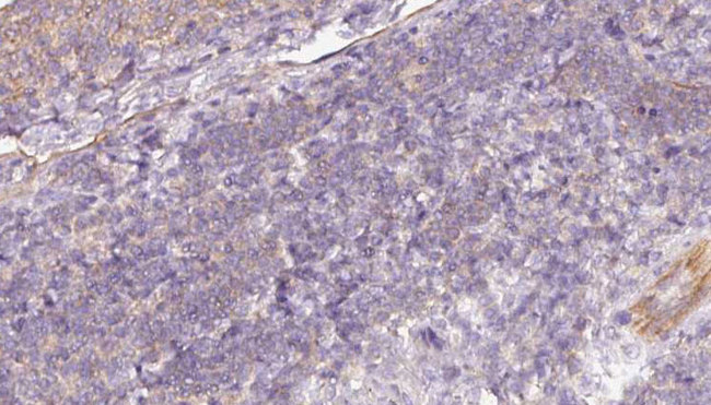 MTHFD2 Antibody - 1:100 staining human lymph carcinoma tissue by IHC-P. The sample was formaldehyde fixed and a heat mediated antigen retrieval step in citrate buffer was performed. The sample was then blocked and incubated with the antibody for 1.5 hours at 22°C. An HRP conjugated goat anti-rabbit antibody was used as the secondary.
