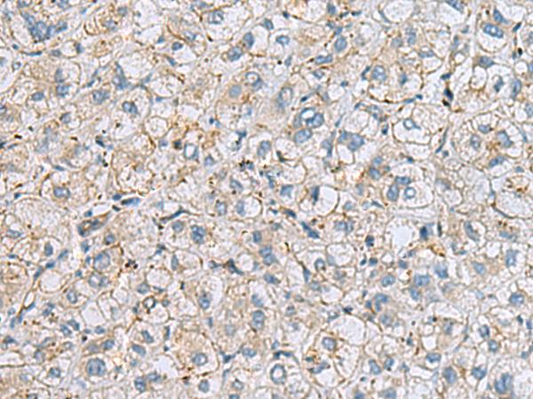 MTHFD2 Antibody - Immunohistochemistry of paraffin-embedded Human liver cancer tissue  using MTHFD2 Polyclonal Antibody at dilution of 1:65(×200)