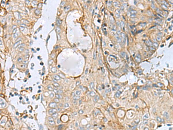 MTHFD2 Antibody - Immunohistochemistry of paraffin-embedded Human colorectal cancer tissue  using MTHFD2 Polyclonal Antibody at dilution of 1:65(×200)