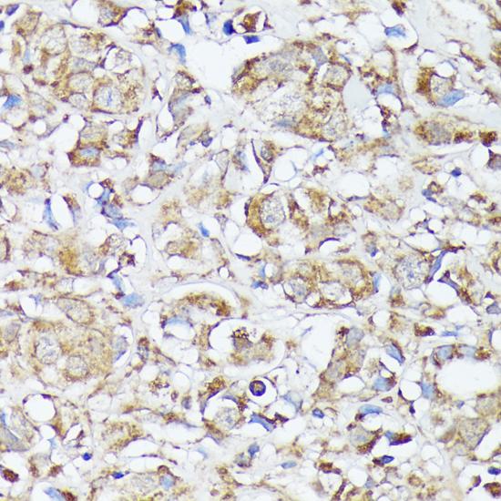 MTHFD2 Antibody - Immunohistochemistry of paraffin-embedded Human mammary cancer using MTHFD2 Polyclonal Antibody at dilution of 1:100 (40x lens).
