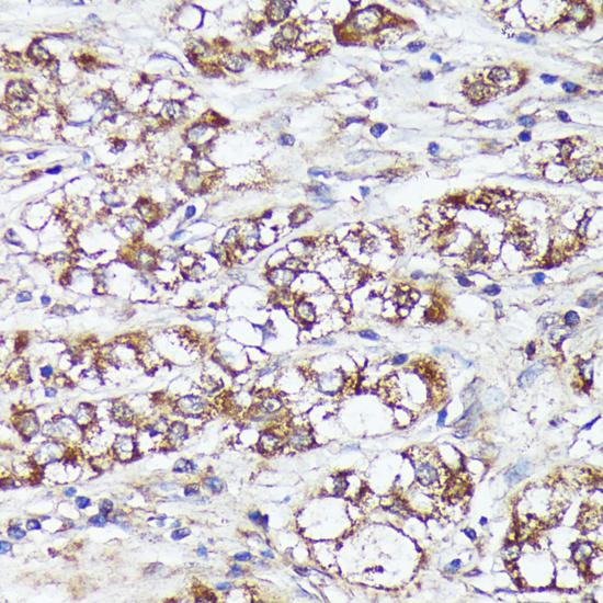 MTHFD2 Antibody - Immunohistochemistry of paraffin-embedded Human liver cancer using MTHFD2 Polyclonal Antibody at dilution of 1:100 (40x lens).