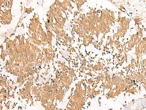 MTHFD2L Antibody - Immunohistochemistry of paraffin-embedded Human lung cancer tissue  using MTHFD2L Polyclonal Antibody at dilution of 1:30(×200)