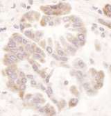 MTHFR Antibody - Detection of Human MTHFR by Immunohistochemistry. Sample: FFPE section of human lung carcinoma. Antibody: Affinity purified rabbit anti-MTHFR used at a dilution of 1:1000 (1 ug/ml). Detection: DAB.