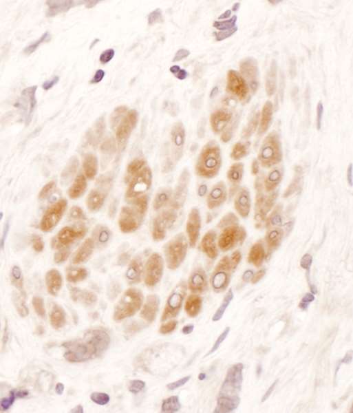 MTHFR Antibody - Detection of Human MTHFR by Immunohistochemistry. Sample: FFPE section of human linitis plastica stomach cancer. Antibody: Affinity purified rabbit anti-MTHFR used at a dilution of 1:1000 (1 ug/ml). Detection: DAB.