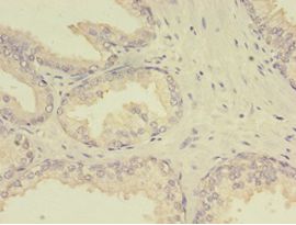 MTHFR Antibody - Immunohistochemistry of paraffin-embedded human prostate cancer using antibody at 1:100 dilution.  This image was taken for the unconjugated form of this product. Other forms have not been tested.