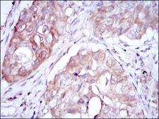 MTHFR Antibody - IHC of paraffin-embedded lung cancer using MTHFR mouse monoclonal antibody with DAB staining.