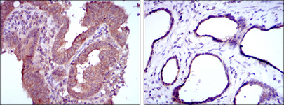 MTHFR Antibody - IHC of paraffin-embedded intima cancer tissues (left) and prostate tissues (right) using MTHFR mouse monoclonal antibody with DAB staining.