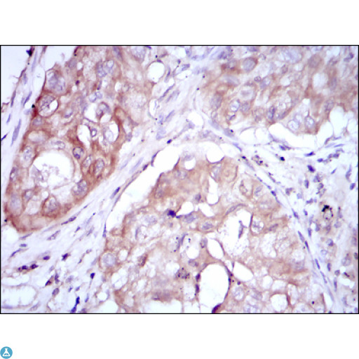 MTHFR Antibody - Immunohistochemistry (IHC) analysis of paraffin-embedded Lung Cancer Tissues with DAB staining using MTHFR Monoclonal Antibody.