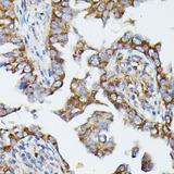 MTIF2 Antibody - Immunohistochemistry of paraffin-embedded Human lung cancer using MTIF2 Polyclonal Antibody at dilution of 1:100 (40x lens).