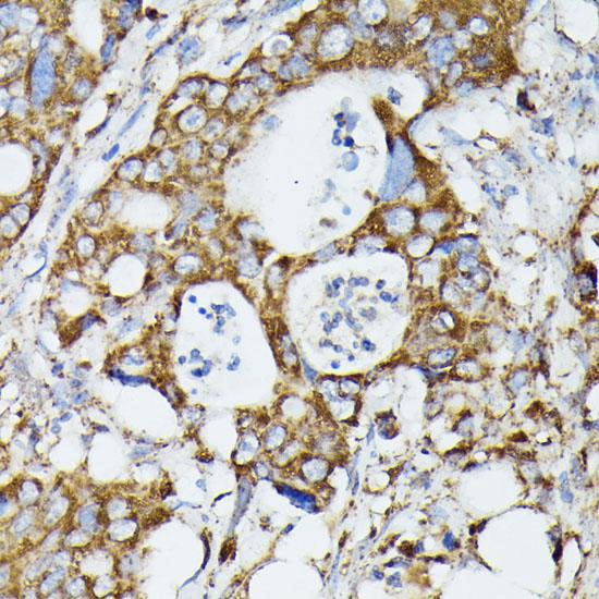 MTIF2 Antibody - Immunohistochemistry of paraffin-embedded Human colon carcinoma using MTIF2 Polyclonal Antibody at dilution of 1:100 (40x lens).