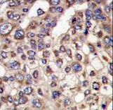 MTMR4 Antibody - Formalin-fixed and paraffin-embedded human hepatocarcinoma tissue reacted with MTMR4 antibody , which was peroxidase-conjugated to the secondary antibody, followed by DAB staining. This data demonstrates the use of this antibody for immunohistochemistry; clinical relevance has not been evaluated.