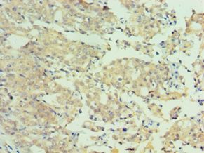 MTMR4 Antibody - Immunohistochemistry of paraffin-embedded human rectal cancer using antibody at 1:100 dilution.