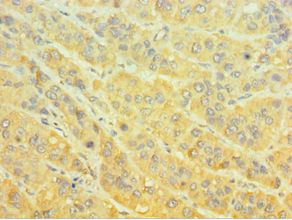 MTMR4 Antibody - Immunohistochemistry of paraffin-embedded human liver cancer using antibody at 1:100 dilution.