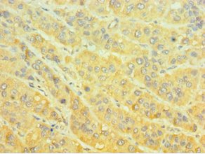 MTMR4 Antibody - Immunohistochemistry of paraffin-embedded human liver cancer using MTMR4 Antibody at dilution of 1:100