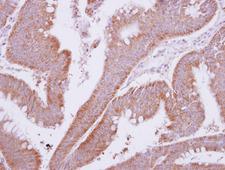 MTMR9 Antibody - IHC of paraffin-embedded Colon ca, using MTMR9 antibody at 1:500 dilution.