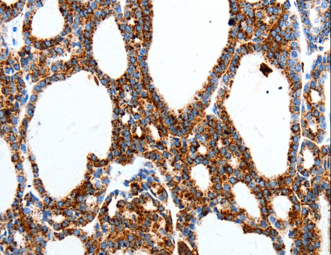 MTNR1A / Melatonin Receptor 1a Antibody - Immunohistochemistry of paraffin-embedded Human thyroid cancer using MTNR1A Polyclonal Antibody at dilution of 1:40.