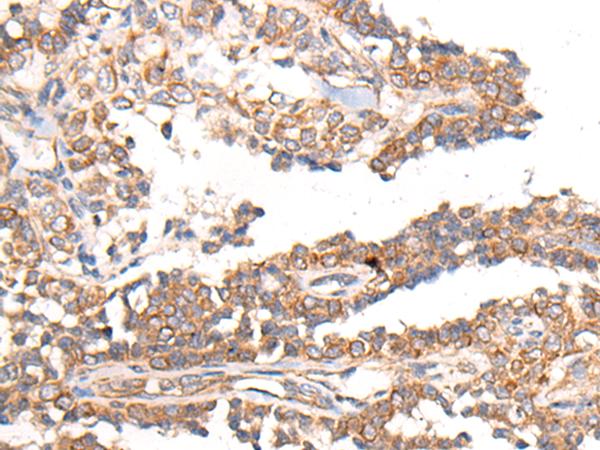MTNR1B / MT2 Antibody - Immunohistochemistry of paraffin-embedded Human ovarian cancer tissue  using MTNR1B Polyclonal Antibody at dilution of 1:55(×200)