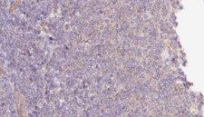 MTO1 Antibody - 1:100 staining human lymph carcinoma tissue by IHC-P. The sample was formaldehyde fixed and a heat mediated antigen retrieval step in citrate buffer was performed. The sample was then blocked and incubated with the antibody for 1.5 hours at 22°C. An HRP conjugated goat anti-rabbit antibody was used as the secondary.